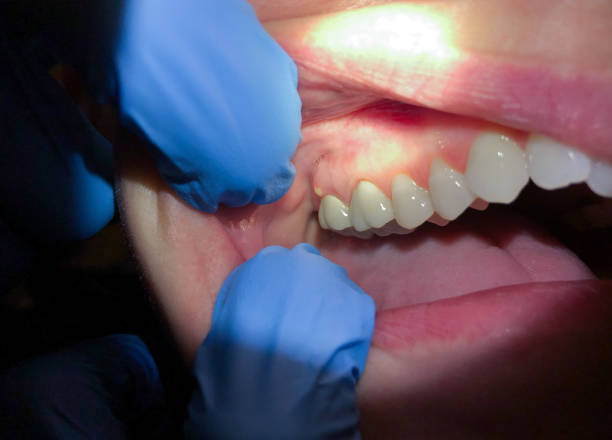 Best Emergency Tooth Extraction in Noroton Heights, CT